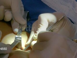 Aj závětří od wwe dostane ji third prsa implant: volný dospělý film 8e
