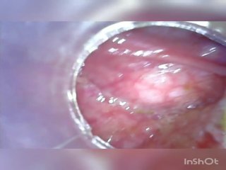 Çuň çuň göte sikişmek again home colonoscopy endoscope part 1